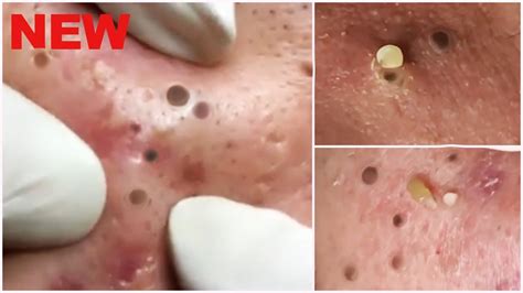 Find the best blackhead removers for nose based on what customers said. Deep Blackheads Removal from Cheeks and Nose - Best Pimple ...