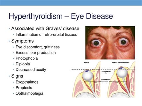 Hyperthyroidism Eyes 28b