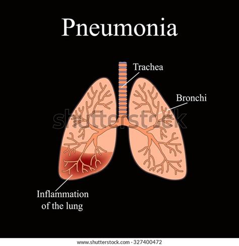 Pneumonia Anatomical Structure Human Lung Illustration Stock