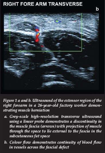 Imaging Diagnosis Of Muscle Herniation Of The Forearm