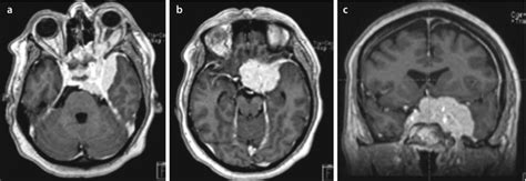 Tumors Of The Skull Base Neupsy Key