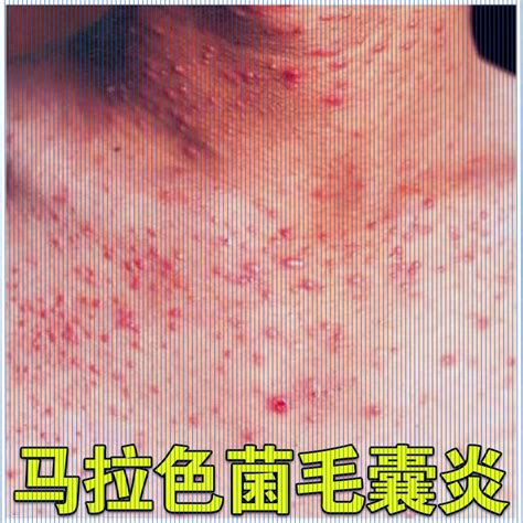﹍scalp Folliculitis Ointment Inflammation Of Hair Follicles Small Red