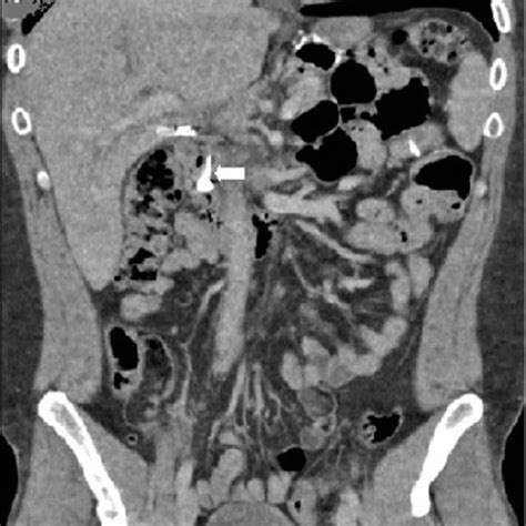 Radiographic Finding During Ercp Intervention Common Bile Duct Is