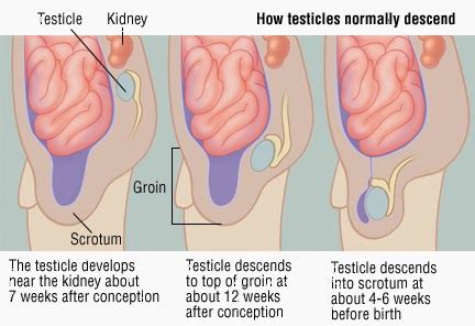 Cryptorchidism is the absence of one or both testes from the scrotum, with the missing testes in the inguinal canal. Sukiman Ishak menulis: 1/1/14 - 2/1/14