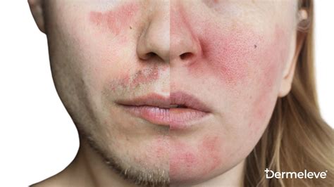 Red Alert Lupus Rash Vs Rosacea The Skin Mystery Unraveled Dermeleve