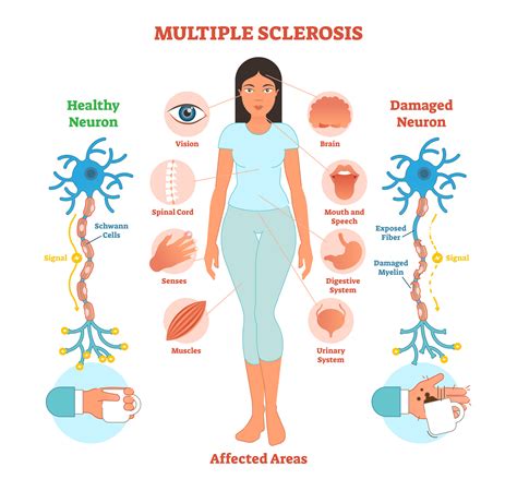 Multiple Sclerosis Patient