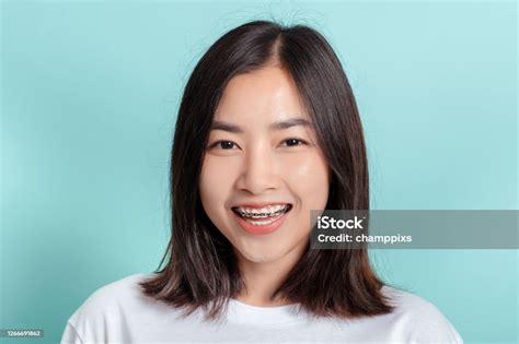 Kawat Gigi Wanita Muda Asia Yang Mengenakan Kawat Gigi Senyum Kecantikan Dengan Gigi Putih