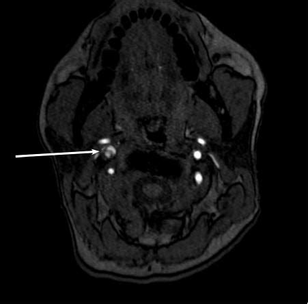 Spontaneous Carotid Artery Dissection In Pregnancy