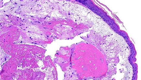 Pathology Outlines Vocal Cord Polyp