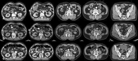 Transverse Images Of A Contrast Enhanced Abdominal Computed Tomography