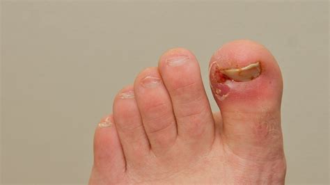 Should You See A Podiatrist For Ingrown Toenails