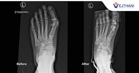 Beauty Is Pain “toe Deformities” Could Be A Silent Threat To Working