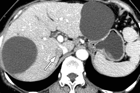 Adrenal Cortical Adenoma In Adrenohepatic Fusion Tissue A Mimic Of