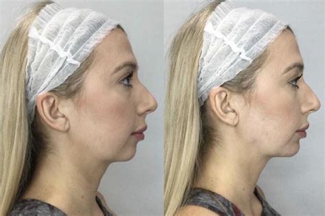 Dermal Fillers Before And After Pictures Case 22 Sacramento Ca