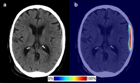 Representative Intracranial Haemorrhages Of Non Contrast Brain Computed