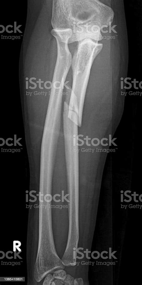 Monteggia Fracture Proximal Ulna Fracture With Radial Head Dislocation