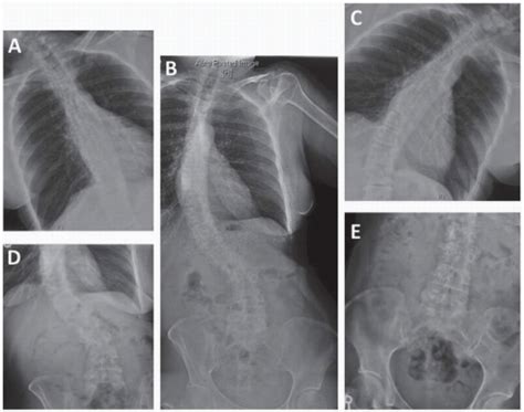 Adult Scoliosis Musculoskeletal Key