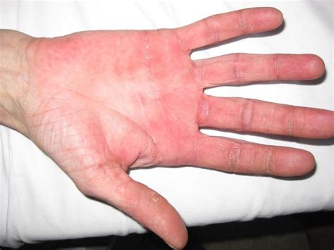 Hand Foot Skin Reaction Multikinase Inhibitor Skin Toxicity Oncologypro