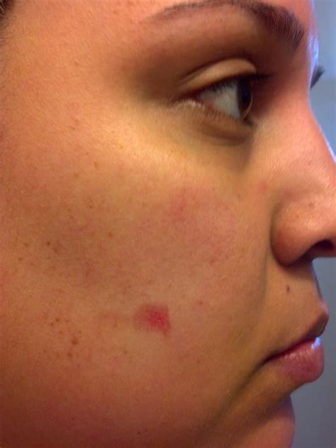 Burn On My Right Cheek After Receiving Laser Hair Removal On My Upper