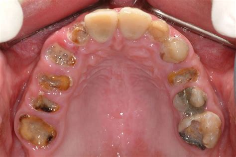 Severe Tooth Decay American College Of Prosthodontists