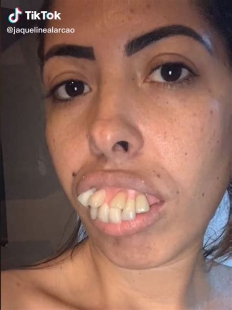 Truth About Jaqueline Alarc Os Viral Teeth Transformation In Tiktok