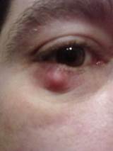 Eyelid Stye Medication Images