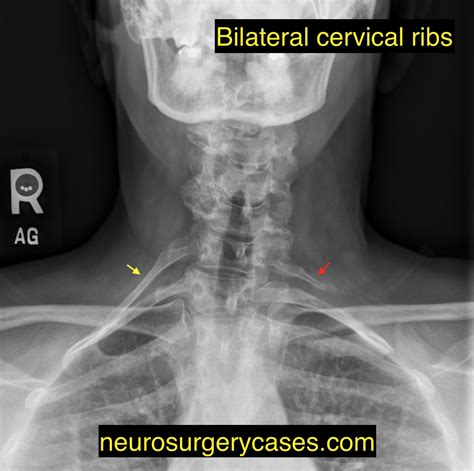 Cervical Rib And Tos