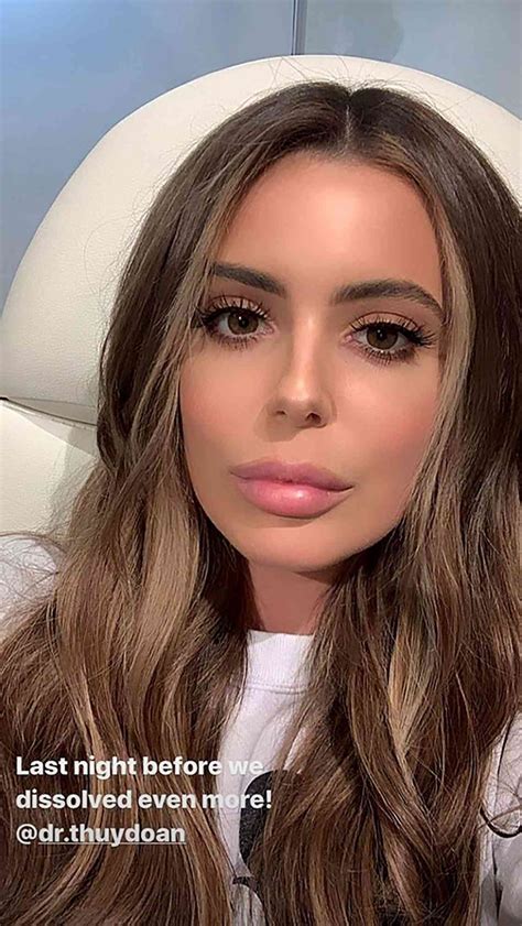 Brielle Biermann Reveals New Look After Dissolving Lip Fillers