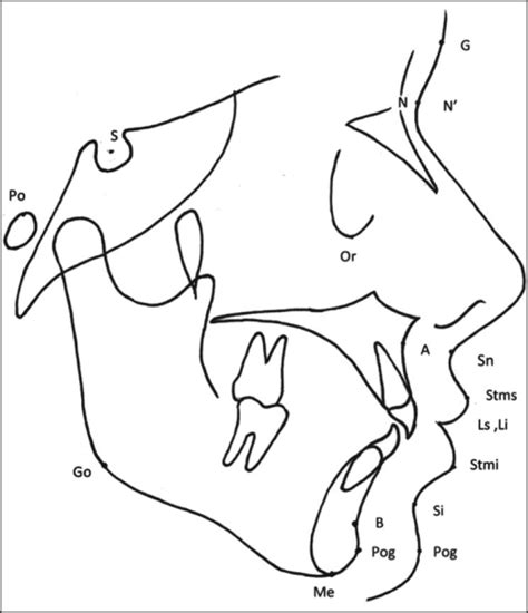 Soft And Hard Tissue Cephalometric Landmarks Used In Th Open I
