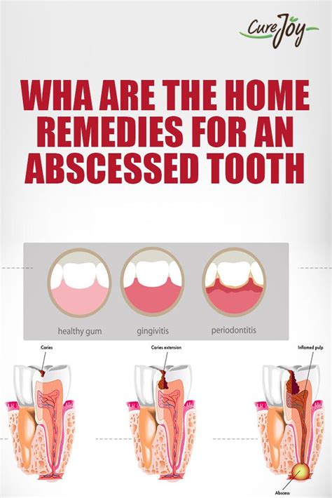 What Are The Home Remedies For An Abscessed Tooth Remedies Home