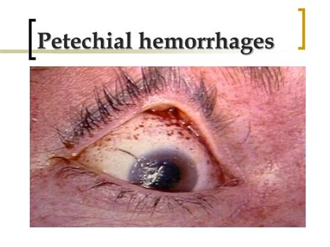 Ppt Presence Of Periorbital And Conjunctival Petechial Hemorrhages In