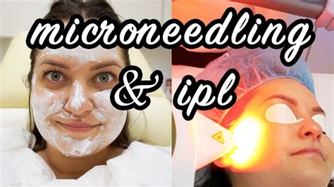 My Microneedling And Ipl Experience Before And After Ela Bobak