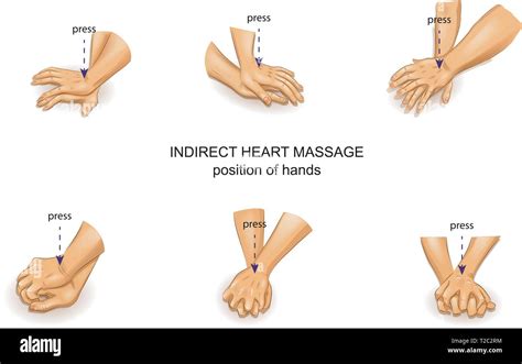 Vector Illustration Of The Position Of The Doctor S Hands In Indirect Heart Massage Stock Vector