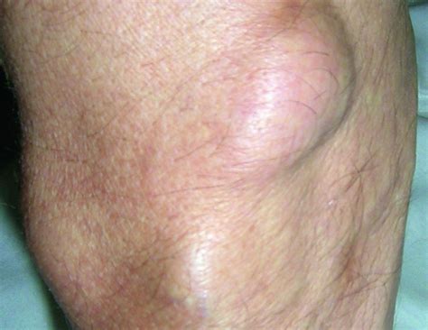 Painless Lump On Lower Leg Lipoma