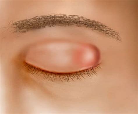 Eyelid Lumps And Bumps Dambrosio Eye Care Stye Chalazion