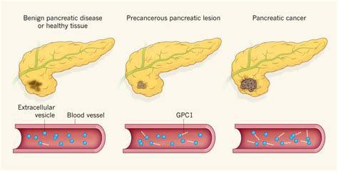 Car T Cell Immunotherapy And Stem Cells For Pancreas Cancer
