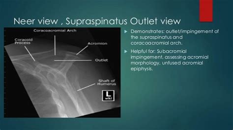 Radiological Anatomy Of Upper Limbshoulderelbow