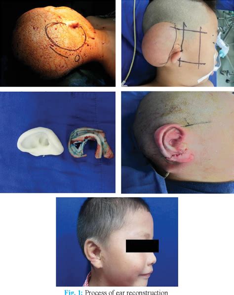 Figure From Microtia Ear Reconstruction Using Tissue Expander And