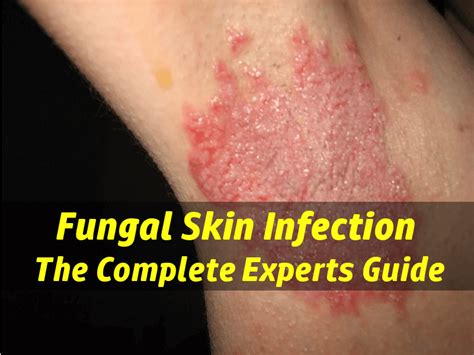 Infection on lip can be due to many causes. Skin Fungus Infection - Are You Treating The Cause or The ...