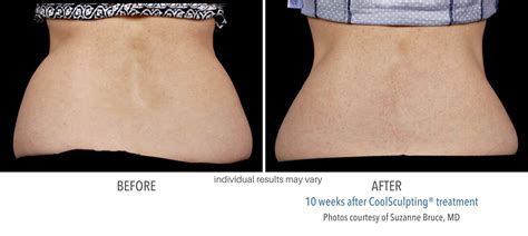 CoolSculpting Before & After Images | Real Patient Results