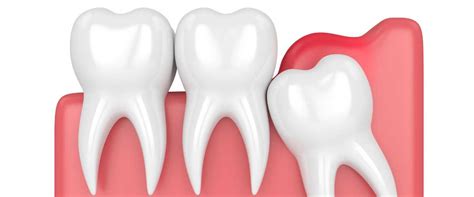 What Are Impacted Wisdom Teeth National Dental Care National