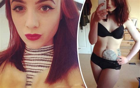 More Than Your Bag Blogger Hattie Gladwell Says Living With A Stoma And An Ileostomy Bag Has