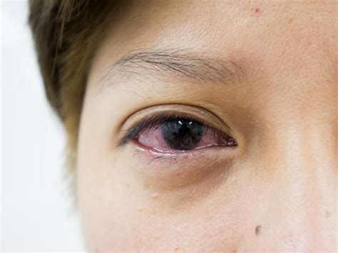 How Can Psoriasis Affect Your Eyes