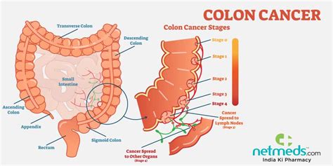 Colon Cancer Causes Symptoms And Treatment