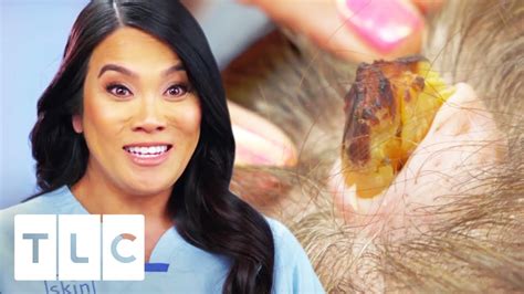 Removing A Horn Like Growth And 6 Cysts From Womans Head Dr Pimple Popper Youtube