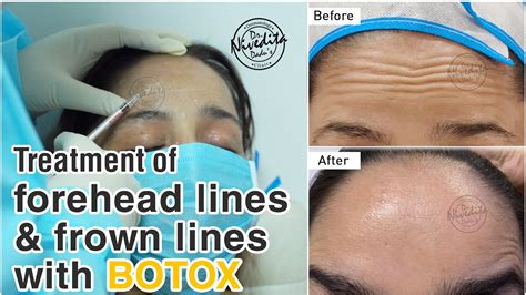 Botox Before And After Botox Injections Treatment Of Forehead Lines