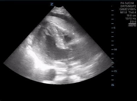 Case 25 Aortic Dissection Ucsd Ultrasound