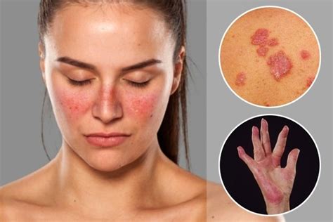 Lupus Symptoms Top 15 Signs And How Its Diagnosed Tua Saúde