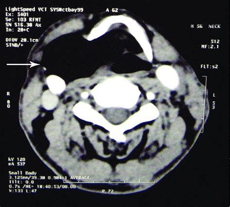 This Preoperative Axial Ct Scan Of The Soft Tissues Of The Neck Reveals