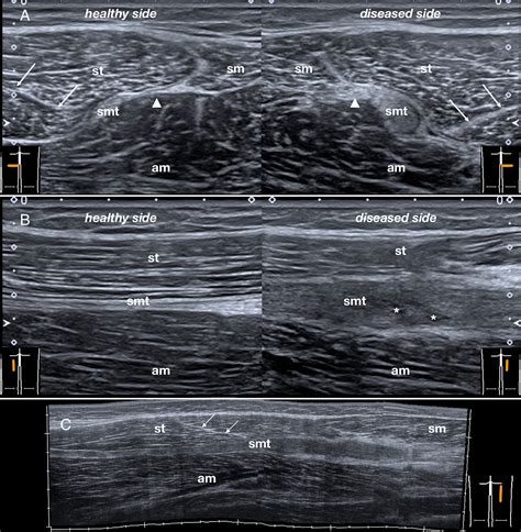 Ultrasound Features Of The Proximal Hamstring Muscle‐tendon‐bone Unit